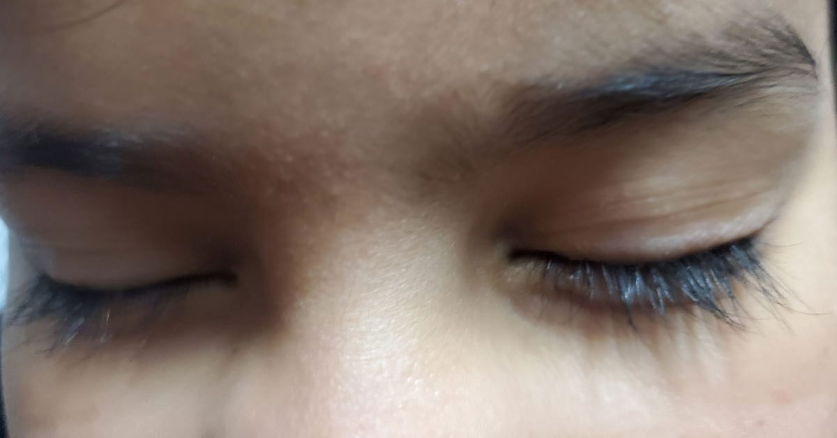 Why do my eyes blink uncontrollably? Medical Outline